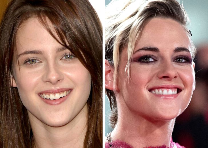 15 celebrità che hanno cambiato i loro denti e che ora possono stupire tutti con il loro sorriso perfetto