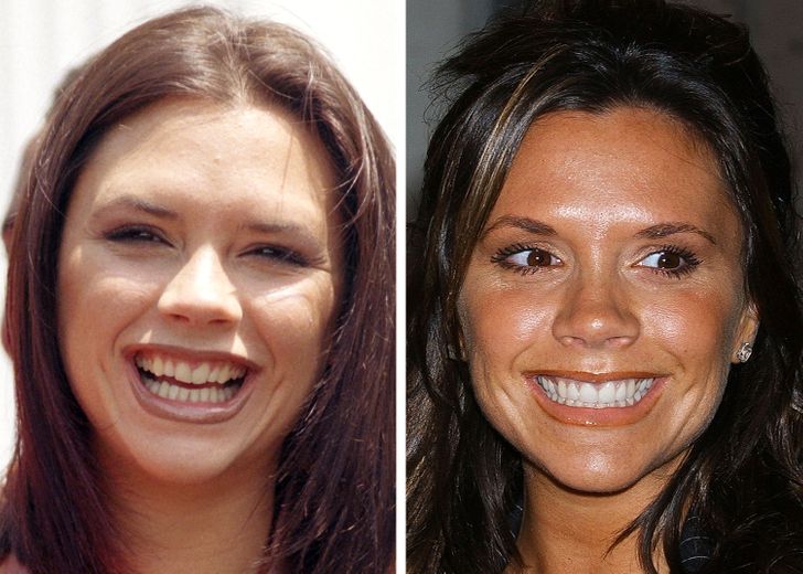 15 celebrità che hanno cambiato i loro denti e che ora possono stupire tutti con il loro sorriso perfetto