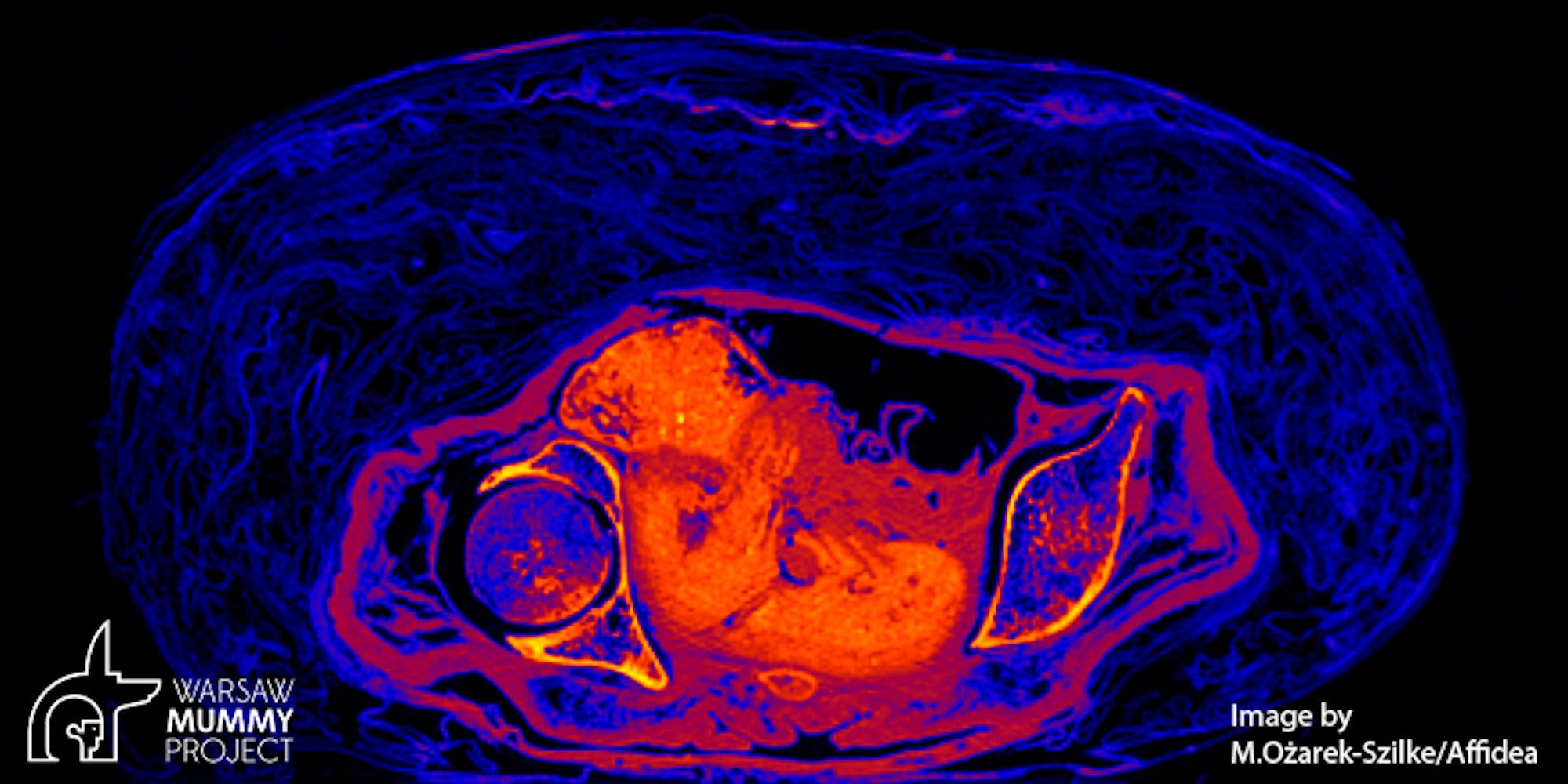 Una sezione trasversale della mummia mostra la forma del feto morto nel corpo della mummia.